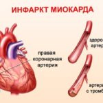 shuntirovanie-serdtsa-sut-operatsii-e1589561825103 Шунтирование сердца - операция и предпосылки
