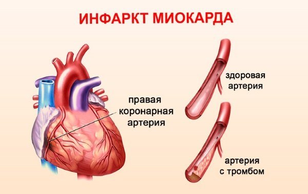 Инфаркт миокарда — симптомы, лечение, причины