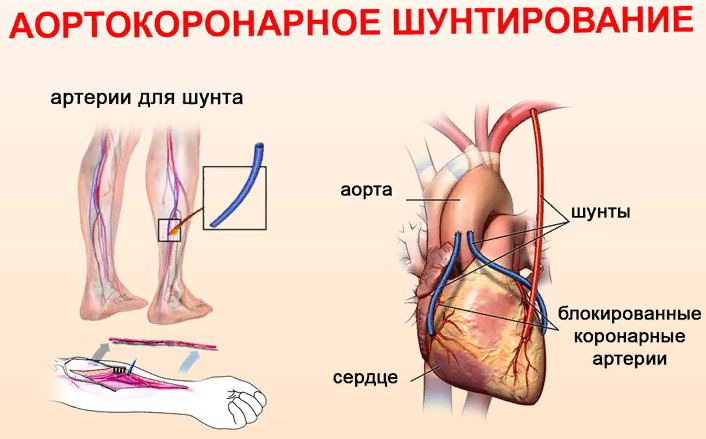 Шунтирование сердца — операция и предпосылки