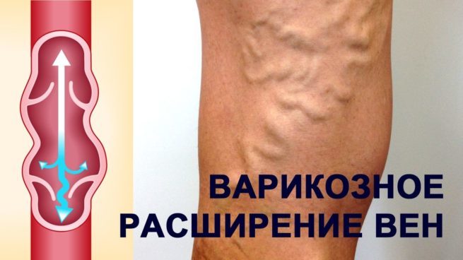operaciya-po-udaleniyu-varikoza-na-nogah-lazerom-e1580146159924 Современные методы лечения варикозного расширения вен