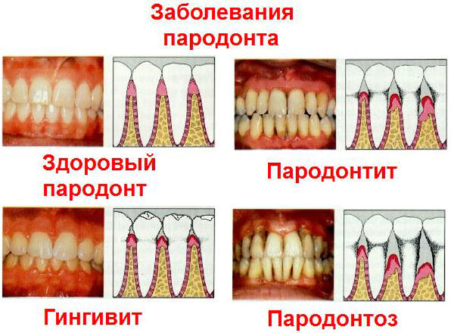 parodontit-i-parodontoz-v-chem-otlichiya-e1591514873565 Против пародонтита - советы по лечению