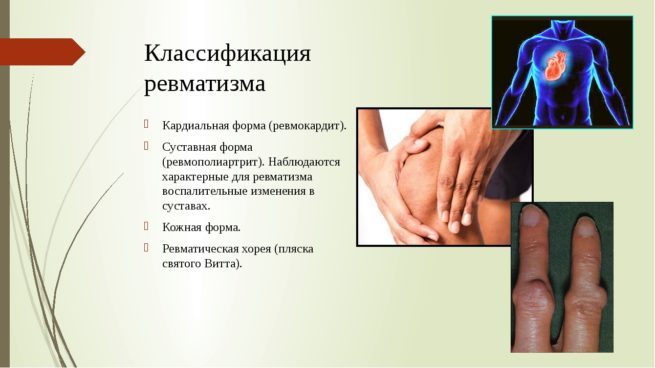 revmatizm-simptomy-u-vzroslykh-kakie-i-lechenie-e1591512090309 Ревматизм - симптомы, причины и лечение